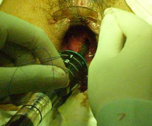 phương pháp mỗ trĩ bằng longo